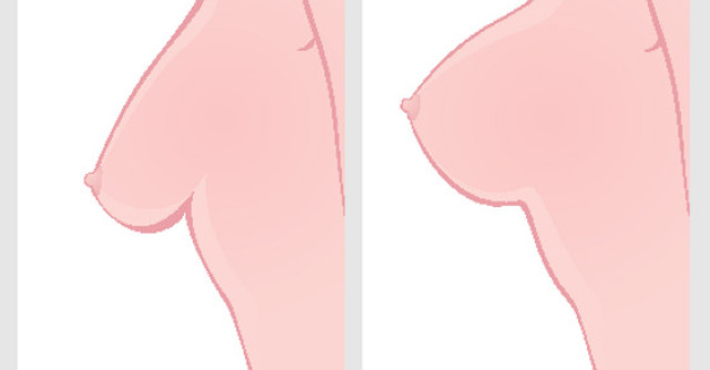 Liftingul mamar: pariu cu timpul si gravitatia