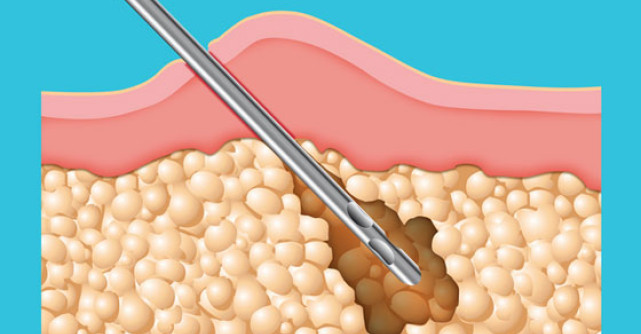 Liposculptura - o alternativa la implantul fesier