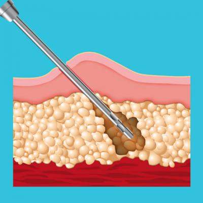 Liposculptura - o alternativa la implantul fesier