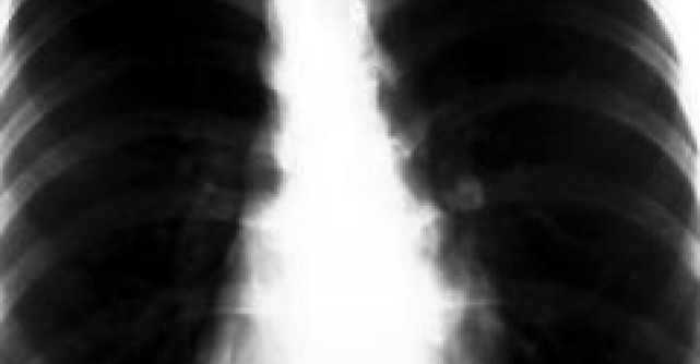 TBC - Sa luptam impreuna pentru combaterea acestei boli