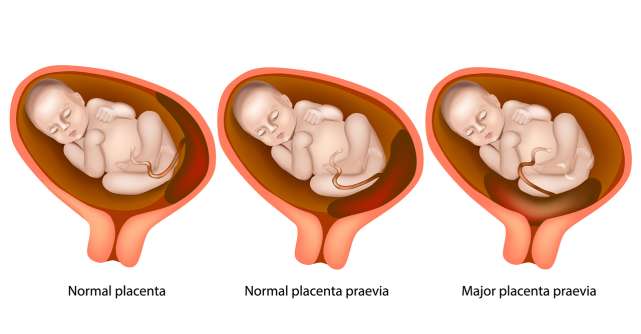 Placenta Praevia: ce înseamnă, cauze, simptome și tratament