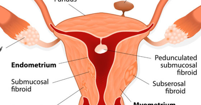 Peste 50% dintre pacientele din Romania sunt diagnosticate cu fibrom uterin