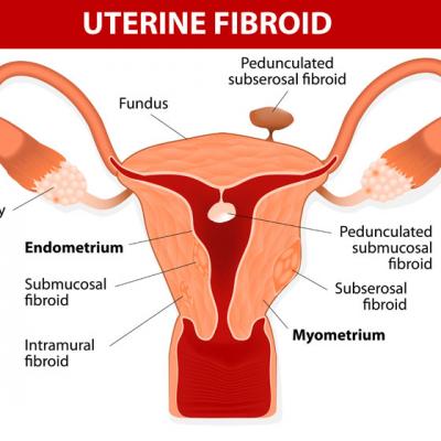 Peste 50% dintre pacientele din Romania sunt diagnosticate cu fibrom uterin