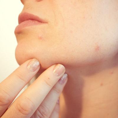 Aspirina in tratarea acneei – eficienta sau nu?