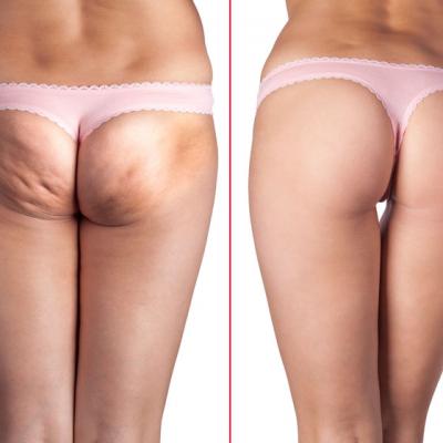 Cum sa scapi de CELULITA: metoda INCREDIBILA!