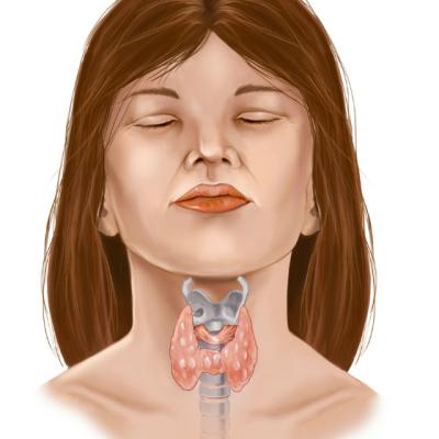 7 Analize pentru TIROIDITA autoimuna Hashimoto