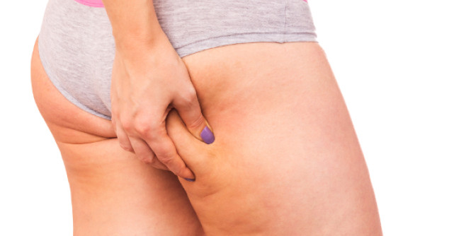 5 solutii pentru a scapa de CELULITA pana la vara!