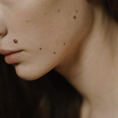 Ce secret incredibil pot dezvălui alunițele tale? Ai o aluniță pe gât, spate sau buze? Află ce destin îți este scris pe piele