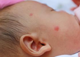 Alergia la proteina laptelui de vacă la bebeluși