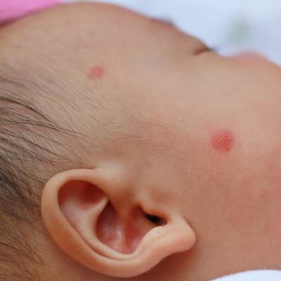 Informații pentru părinți privind alergia la proteina laptelui de vacă a bebelușilor