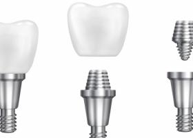 Implant dentar Straumann: de ce este considerat o soluție premium pentru dinții pierduți