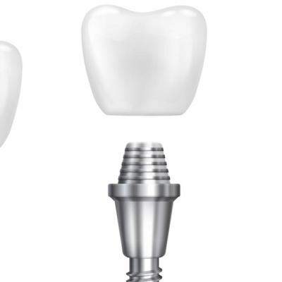 Implant dentar Straumann: de ce este considerat o soluție premium pentru dinții pierduți