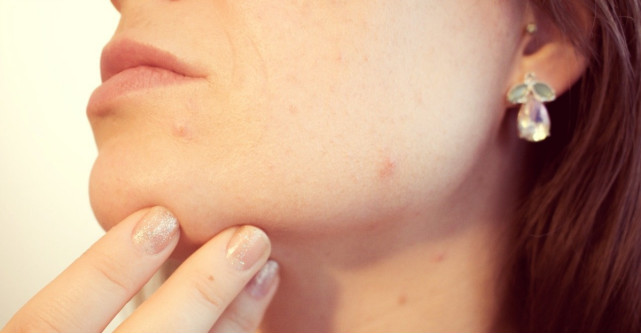 Aspirina in tratarea acneei – eficienta sau nu?