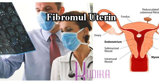 Fibromul uterin - tumora din uter care creste in tacere