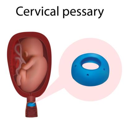 Ce este un pesar, ce trebuie să știe femeia însărcinată și cum ajută în incontinența de col sau 