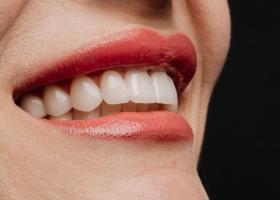 Fațete dentare vs. alte proceduri estetice: factori de luat în considerare înainte de a face alegerea