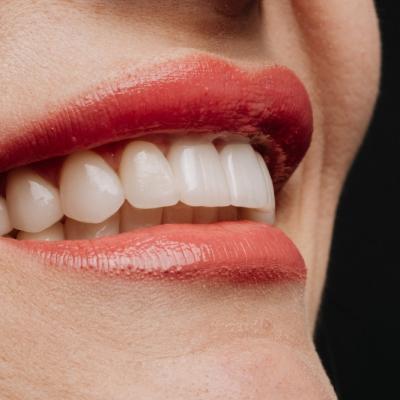 Fațete dentare vs. alte proceduri estetice: factori de luat în considerare înainte de a face alegerea 
