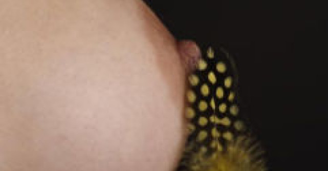 Mamoplastia - intre estetic si necesar