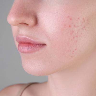Ce spune zona în care îți apare acneea despre sănătatea ta? 