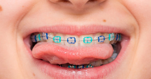 Aparatele dentare la copii: moft sau necesitate medicală? Ce spun studiile și practica ortodontică