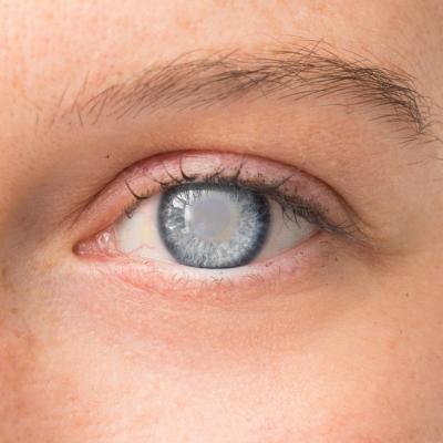 Totul despre cataracta, afectiunea periculoasa care poate duce la pierderea vederii