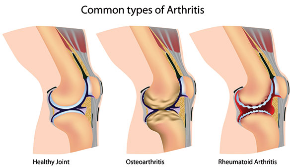 5 semne de gonartroză. Cum se tratează artroza genunchiului în funcție de stadiul bolii