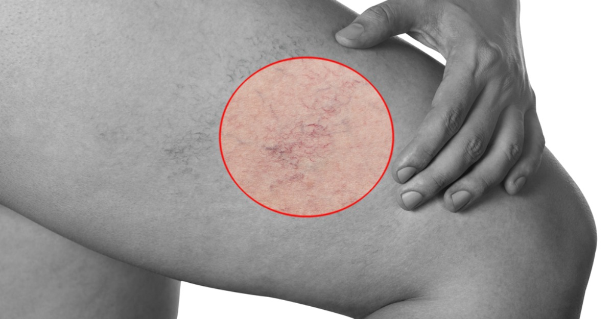 bandage varicoasa pentru genunchi tratai vene varicoase prin revizuiri de remedii populare